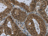 The image on the left is immunohistochemistry of paraffin-embedded Human colon cancer tissue using CSB-PA056873 (MRE11A Antibody) at dilution 1/60, on the right is treated with fusion protein. (Original magnification: ×200)