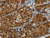 The image on the left is immunohistochemistry of paraffin-embedded Human breast cancer tissue using CSB-PA926920 (MRE11A Antibody) at dilution 1/60, on the right is treated with fusion protein. (Original magnification: ×200)