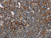 The image on the left is immunohistochemistry of paraffin-embedded Human cervical cancer tissue using CSB-PA298637 (MRPL12 Antibody) at dilution 1/25, on the right is treated with fusion protein. (Original magnification: ×200)