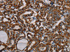 The image on the left is immunohistochemistry of paraffin-embedded Human thyroid cancer tissue using CSB-PA259631 (MRPL12 Antibody) at dilution 1/20, on the right is treated with fusion protein. (Original magnification: ×200)