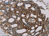 The image on the left is immunohistochemistry of paraffin-embedded Human cervical cancer tissue using CSB-PA259631 (MRPL12 Antibody) at dilution 1/20, on the right is treated with fusion protein. (Original magnification: ×200)
