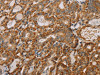 The image on the left is immunohistochemistry of paraffin-embedded Human thyroid cancer tissue using CSB-PA782082 (MTFR1 Antibody) at dilution 1/40, on the right is treated with fusion protein. (Original magnification: ×200)