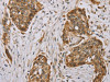 The image on the left is immunohistochemistry of paraffin-embedded Human esophagus cancer tissue using CSB-PA089757 (MVK Antibody) at dilution 1/40, on the right is treated with fusion protein. (Original magnification: ×200)