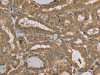 The image on the left is immunohistochemistry of paraffin-embedded Human thyroid cancer tissue using CSB-PA229254 (MVK Antibody) at dilution 1/20, on the right is treated with fusion protein. (Original magnification: ×200)