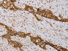 The image on the left is immunohistochemistry of paraffin-embedded Human esophagus cancer tissue using CSB-PA229254 (MVK Antibody) at dilution 1/20, on the right is treated with fusion protein. (Original magnification: ×200)