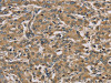 The image on the left is immunohistochemistry of paraffin-embedded Human liver cancer tissue using CSB-PA249474 (MYL3 Antibody) at dilution 1/45, on the right is treated with fusion protein. (Original magnification: ×200)