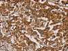 The image on the left is immunohistochemistry of paraffin-embedded Human liver cancer tissue using CSB-PA212278 (MB Antibody) at dilution 1/25, on the right is treated with fusion protein. (Original magnification: ×200)