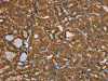 The image on the left is immunohistochemistry of paraffin-embedded Human thyroid cancer tissue using CSB-PA923759 (NGFRAP1 Antibody) at dilution 1/40, on the right is treated with fusion protein. (Original magnification: ×200)