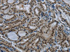 The image on the left is immunohistochemistry of paraffin-embedded Human thyroid cancer tissue using CSB-PA789655 (NBL1 Antibody) at dilution 1/50, on the right is treated with fusion protein. (Original magnification: ×200)