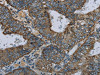 The image on the left is immunohistochemistry of paraffin-embedded Human colon cancer tissue using CSB-PA579687 (NDUFA5 Antibody) at dilution 1/60, on the right is treated with fusion protein. (Original magnification: ×200)
