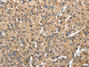 The image on the left is immunohistochemistry of paraffin-embedded Human liver cancer tissue using CSB-PA796983 (NDUFA5 Antibody) at dilution 1/40, on the right is treated with fusion protein. (Original magnification: ×200)