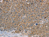 The image on the left is immunohistochemistry of paraffin-embedded Human ovarian cancer tissue using CSB-PA107998 (NDUFS7 Antibody) at dilution 1/40, on the right is treated with fusion protein. (Original magnification: ×200)