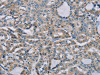 The image on the left is immunohistochemistry of paraffin-embedded Human thyroid cancer tissue using CSB-PA121181 (NDUFS7 Antibody) at dilution 1/20, on the right is treated with fusion protein. (Original magnification: ×200)