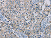 The image on the left is immunohistochemistry of paraffin-embedded Human breast cancer tissue using CSB-PA121181 (NDUFS7 Antibody) at dilution 1/20, on the right is treated with fusion protein. (Original magnification: ×200)