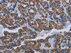 The image on the left is immunohistochemistry of paraffin-embedded Human thyroid cancer tissue using CSB-PA193298 (NDUFS8 Antibody) at dilution 1/20, on the right is treated with fusion protein. (Original magnification: ×200)