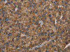 The image on the left is immunohistochemistry of paraffin-embedded Human liver cancer tissue using CSB-PA163325 (PVRL2 Antibody) at dilution 1/40, on the right is treated with fusion protein. (Original magnification: ×200)