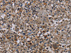 The image on the left is immunohistochemistry of paraffin-embedded Human lung cancer tissue using CSB-PA190585 (PVRL4 Antibody) at dilution 1/60, on the right is treated with fusion protein. (Original magnification: ×200)