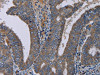 The image on the left is immunohistochemistry of paraffin-embedded Human colon cancer tissue using CSB-PA232987 (PVRL4 Antibody) at dilution 1/40, on the right is treated with fusion protein. (Original magnification: ×200)