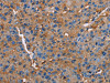 The image on the left is immunohistochemistry of paraffin-embedded Human liver cancer tissue using CSB-PA928711 (NLGN1 Antibody) at dilution 1/50, on the right is treated with fusion protein. (Original magnification: ×200)