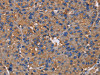 The image on the left is immunohistochemistry of paraffin-embedded Human liver cancer tissue using CSB-PA229917 (NCSTN Antibody) at dilution 1/50, on the right is treated with fusion protein. (Original magnification: ×200)