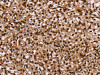 The image on the left is immunohistochemistry of paraffin-embedded Human prostate cancer tissue using CSB-PA921993 (HMGN5 Antibody) at dilution 1/20, on the right is treated with fusion protein. (Original magnification: ×200)