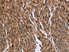 The image on the left is immunohistochemistry of paraffin-embedded Human lung cancer tissue using CSB-PA921993 (HMGN5 Antibody) at dilution 1/20, on the right is treated with fusion protein. (Original magnification: ×200)