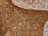 The image on the left is immunohistochemistry of paraffin-embedded Human esophagus cancer tissue using CSB-PA834592 (NT5C1A Antibody) at dilution 1/25, on the right is treated with fusion protein. (Original magnification: ×200)