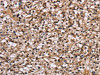 The image on the left is immunohistochemistry of paraffin-embedded Human prostate cancer tissue using CSB-PA255769 (NUP62 Antibody) at dilution 1/50, on the right is treated with fusion protein. (Original magnification: ×200)