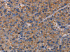 The image on the left is immunohistochemistry of paraffin-embedded Human liver cancer tissue using CSB-PA041313 (NUP62 Antibody) at dilution 1/40, on the right is treated with fusion protein. (Original magnification: ×200)
