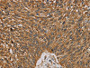 The image on the left is immunohistochemistry of paraffin-embedded Human lung cancer tissue using CSB-PA967640 (NDEL1 Antibody) at dilution 1/20, on the right is treated with fusion protein. (Original magnification: ×200)