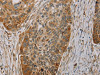 The image on the left is immunohistochemistry of paraffin-embedded Human esophagus cancer tissue using CSB-PA209755 (PAGE2 Antibody) at dilution 1/20, on the right is treated with fusion protein. (Original magnification: ×200)