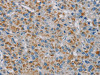 The image on the left is immunohistochemistry of paraffin-embedded Human liver cancer tissue using CSB-PA132878 (PNLIP Antibody) at dilution 1/20, on the right is treated with fusion protein. (Original magnification: ×200)