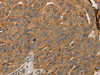 The image on the left is immunohistochemistry of paraffin-embedded Human breast cancer tissue using CSB-PA823996 (PARP11 Antibody) at dilution 1/30, on the right is treated with fusion protein. (Original magnification: ×200)