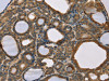 The image on the left is immunohistochemistry of paraffin-embedded Human thyroid cancer tissue using CSB-PA051247 (SCGB2A1 Antibody) at dilution 1/50, on the right is treated with fusion protein. (Original magnification: ×200)