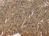 The image on the left is immunohistochemistry of paraffin-embedded Human breast cancer tissue using CSB-PA051247 (SCGB2A1 Antibody) at dilution 1/50, on the right is treated with fusion protein. (Original magnification: ×200)