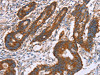 The image on the left is immunohistochemistry of paraffin-embedded Human colon cancer tissue using CSB-PA184980 (PDLIM1 Antibody) at dilution 1/30, on the right is treated with fusion protein. (Original magnification: ×200)
