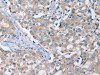 The image on the left is immunohistochemistry of paraffin-embedded Human breast cancer tissue using CSB-PA295602 (PEA15 Antibody) at dilution 1/20, on the right is treated with fusion protein. (Original magnification: ×200)