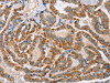 The image on the left is immunohistochemistry of paraffin-embedded Human thyroid cancer tissue using CSB-PA301850 (MSMB Antibody) at dilution 1/30, on the right is treated with fusion protein. (Original magnification: ×200)