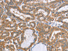 The image on the left is immunohistochemistry of paraffin-embedded Human thyroid cancer tissue using CSB-PA164416 (MSMB Antibody) at dilution 1/20, on the right is treated with fusion protein. (Original magnification: ×200)