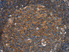 The image on the left is immunohistochemistry of paraffin-embedded Human tonsil tissue using CSB-PA152057 (PFKL Antibody) at dilution 1/25, on the right is treated with fusion protein. (Original magnification: ×200)