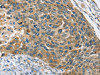 The image on the left is immunohistochemistry of paraffin-embedded Human esophagus cancer tissue using CSB-PA941946 (PHKB Antibody) at dilution 1/20, on the right is treated with fusion protein. (Original magnification: ×200)