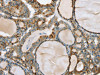 The image on the left is immunohistochemistry of paraffin-embedded Human thyroid cancer tissue using CSB-PA941946 (PHKB Antibody) at dilution 1/20, on the right is treated with fusion protein. (Original magnification: ×200)