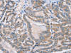 The image on the left is immunohistochemistry of paraffin-embedded Human thyroid cancer tissue using CSB-PA869605 (PHYH Antibody) at dilution 1/30, on the right is treated with fusion protein. (Original magnification: ×200)