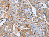 The image on the left is immunohistochemistry of paraffin-embedded Human breast cancer tissue using CSB-PA241730 (PLS3 Antibody) at dilution 1/20, on the right is treated with fusion protein. (Original magnification: ×200)