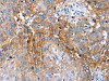 The image on the left is immunohistochemistry of paraffin-embedded Human lung cancer tissue using CSB-PA776342 (PLCZ1 Antibody) at dilution 1/25, on the right is treated with fusion protein. (Original magnification: ×200)