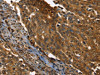 The image on the left is immunohistochemistry of paraffin-embedded Human cervical cancer tissue using CSB-PA014187 (PPIA Antibody) at dilution 1/35, on the right is treated with fusion protein. (Original magnification: ×200)
