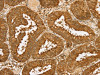 The image on the left is immunohistochemistry of paraffin-embedded Human cervical cancer tissue using CSB-PA113942 (PDP1 Antibody) at dilution 1/30, on the right is treated with fusion protein. (Original magnification: ×200)