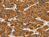 The image on the left is immunohistochemistry of paraffin-embedded Human liver cancer tissue using CSB-PA043015 (PTPN5 Antibody) at dilution 1/30, on the right is treated with fusion protein. (Original magnification: ×200)