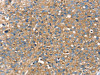 The image on the left is immunohistochemistry of paraffin-embedded Human breast cancer tissue using CSB-PA994941 (RAB9A Antibody) at dilution 1/25, on the right is treated with fusion protein. (Original magnification: ×200)