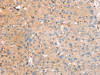 The image on the left is immunohistochemistry of paraffin-embedded Human liver cancer tissue using CSB-PA933652 (RASAL2 Antibody) at dilution 1/40, on the right is treated with fusion protein. (Original magnification: ×200) The image on the left is immunohistochemistry of paraffin-embedded Human liver cancer tissue using CSB-PA933652 (RASAL2 Antibody) at dilution 1/40, on the right is treated with fusion protein. (Original magnification: ×200)